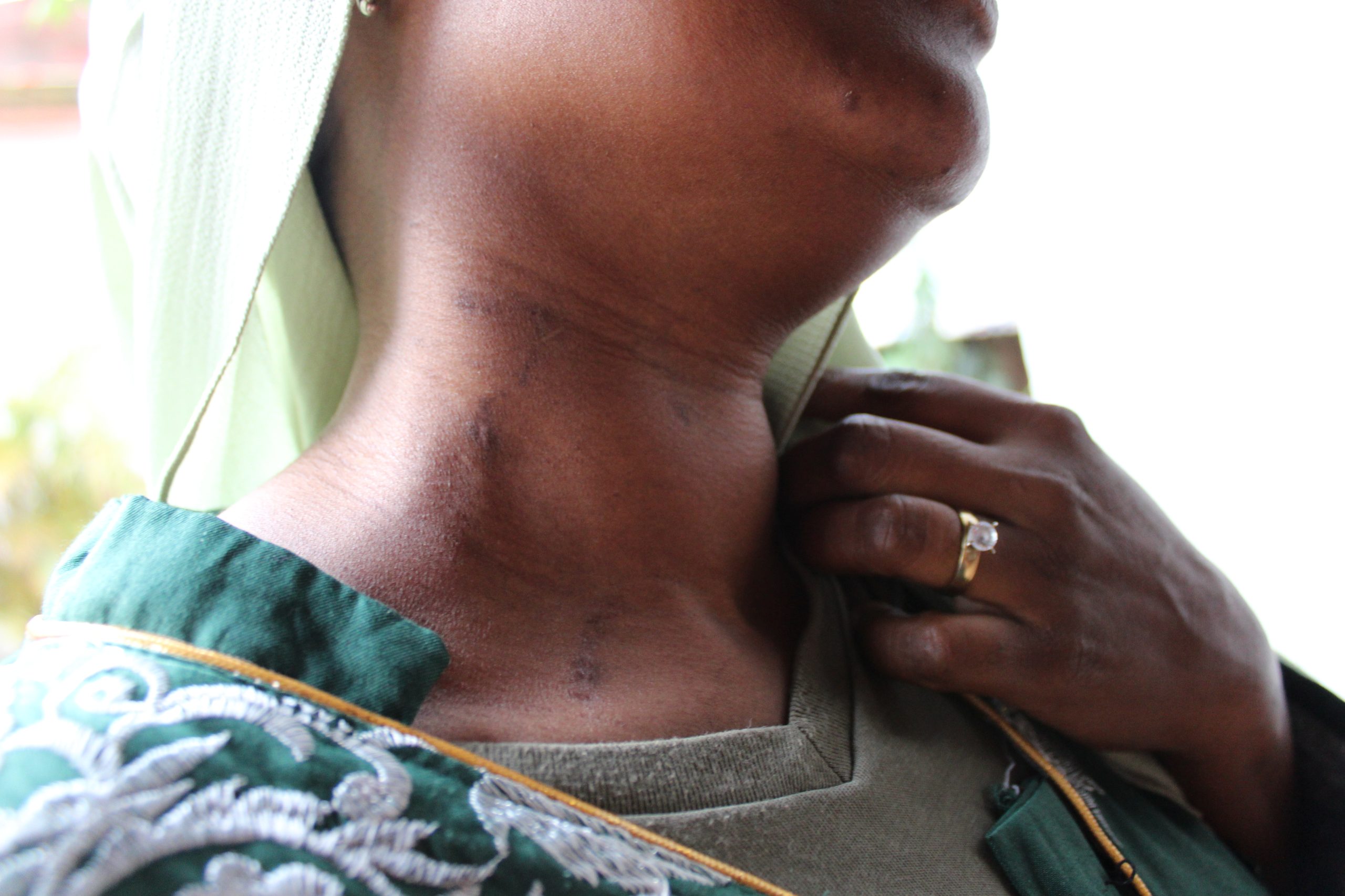 Narben einer Sudanesin, die im Krieg verwundet wurde (Foto: Simone Schlindwein)